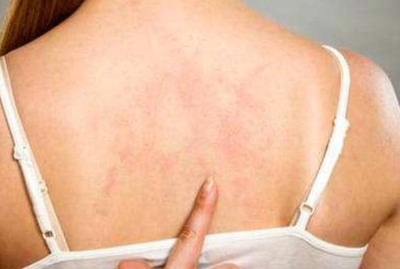 后背長痘痘是什么原因？如何預(yù)防后背長痘？
