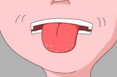 舌苔厚是什么原因？如何避免舌苔厚？
