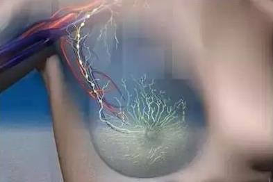 乳腺癌惡變有哪些表現(xiàn)？如何預(yù)防乳腺癌變？