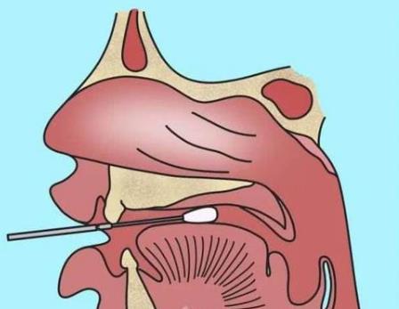 核酸檢測新冠病毒的常用手段：口腔拭子、鼻腔拭子檢測圖示
