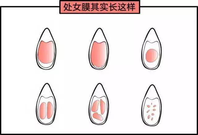 14歲女孩處女膜長什么樣？14歲女孩有處女膜嗎？[圖]