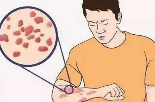 蕁麻疹是怎么引起的？蕁麻疹有哪些危害？