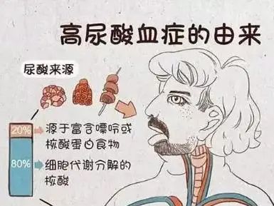 鄭州痛風(fēng)專家：無癥狀高尿酸血癥，是否需要降尿酸治療？
