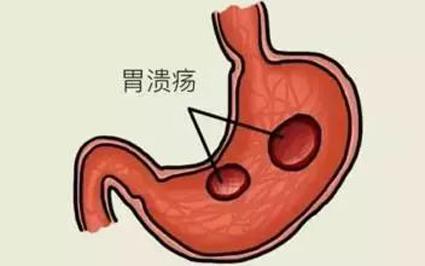 曲靖東大中醫(yī)肛腸醫(yī)院專(zhuān)業(yè)嗎？有胃潰瘍還暴飲暴食，擔(dān)心胃穿孔