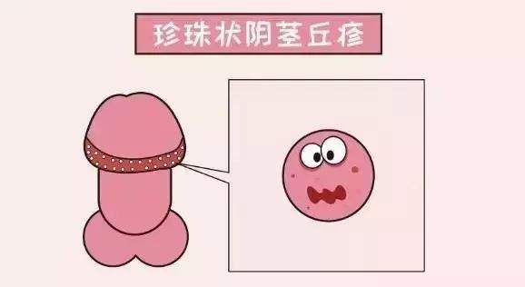 龜頭上有小雞皮疙瘩是什么？龜頭邊緣有很多疙瘩正常嗎？