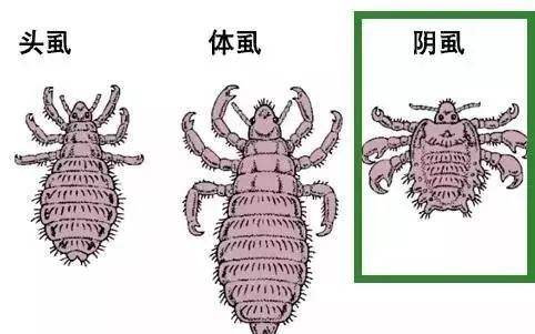 陰虱病是什么??？什么原因造成陰虱？[圖]