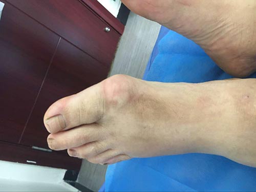 鄭州痛風(fēng)風(fēng)濕病醫(yī)院：吳女士尚未衰老卻腳步劇痛，沒想到查出了它