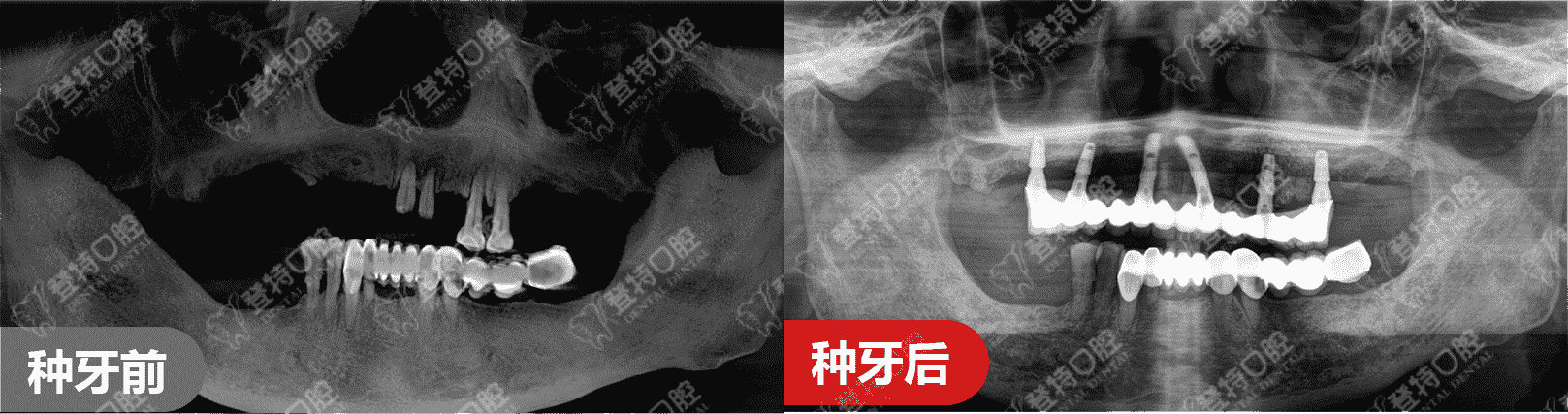 顛覆傳統(tǒng)種牙，佛山登特口腔一日得技術(shù)，一天搞定種牙全過(guò)程