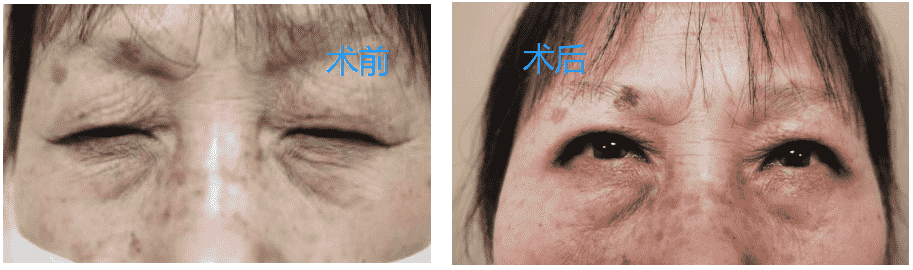 【福州愛爾眼科】三明大姐眼睛睜不開，走路得抬頭，竟然是“上瞼下垂”惹的禍