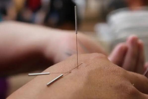 針灸減肥效果好嗎？針灸減肥適合多大年齡？