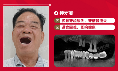 全口種牙去哪家醫(yī)院好？90%的佛山人都選擇佛山登特口腔