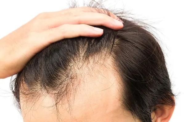 怎樣防止脫發(fā)？染發(fā)后脫發(fā)怎么辦？