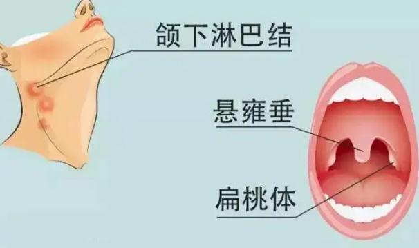 慢性扁桃體炎飲食禁忌有哪些？慢性扁桃體炎怎么治？