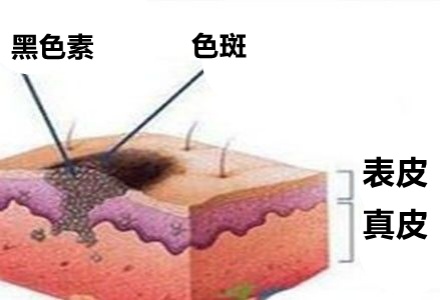 祛斑霜用出終生難愈皮炎，千金散去再也換不回一張健康臉！
