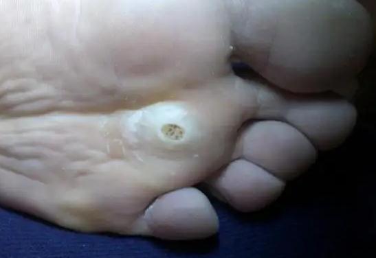 雞眼是怎么形成的？腳上長雞眼怎么去除？