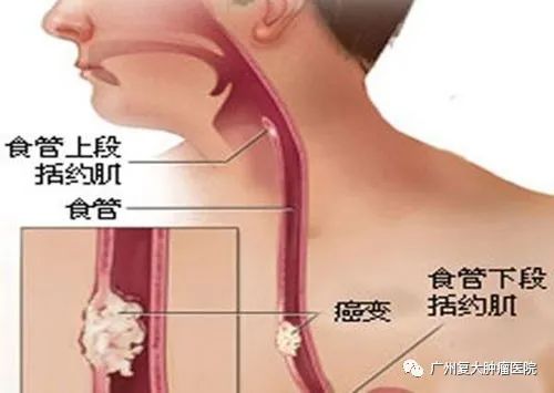 杭州腫瘤醫(yī)院請選擇廣州復大腫瘤醫(yī)院：食管癌轉(zhuǎn)移后要怎么治療