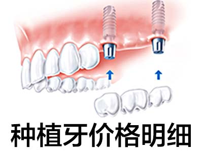 種植槽牙多少錢(qián) 天津北辰種植后槽牙多少錢(qián)一顆