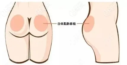 胖還是瘦對(duì)豐臀有什么作用嗎？任學(xué)會(huì)如何評(píng)價(jià)脂肪豐臀相關(guān)問(wèn)題？