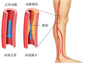 濟南中醫(yī)靜脈曲張醫(yī)院到底怎么去 謹(jǐn)防收費陷阱