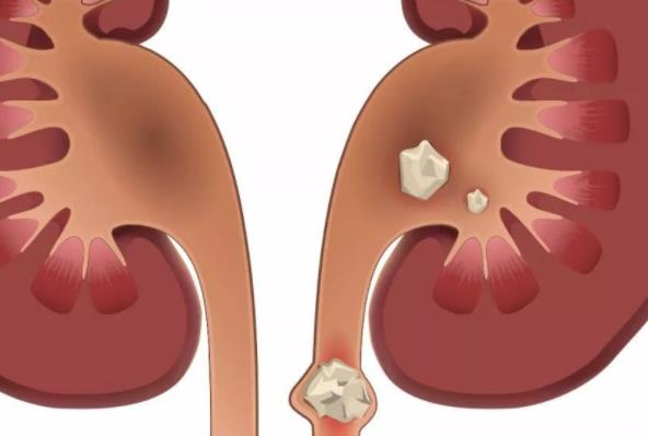 腎結石有哪些癥狀 腰腹部絞痛惡心腹脹血尿