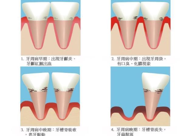牙周炎怎么治療 藥物去除牙石殺菌手術