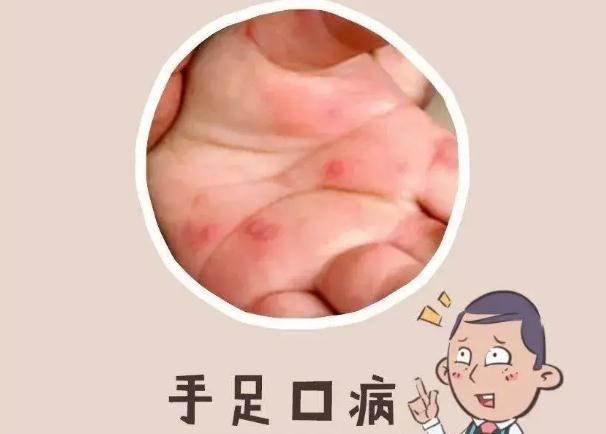手足口病怎樣預(yù)防？手足口病潛伏期有多久？
