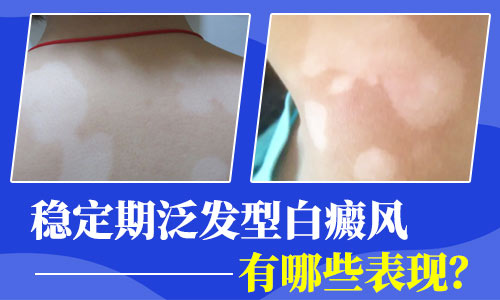 穩(wěn)定期泛發(fā)型白癜風有哪些表現？長沙華研新技術攻關頑固型&大面積白癜風