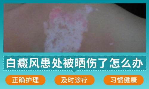 白癜風患處被曬傷了怎么辦？寧波華仁科學規(guī)范診療教你正確防治