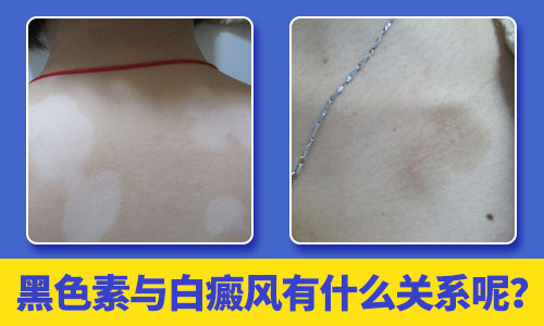 脖子部位白癜風(fēng)擴(kuò)散到嘴角了？寧波華仁患者滿意的醫(yī)院