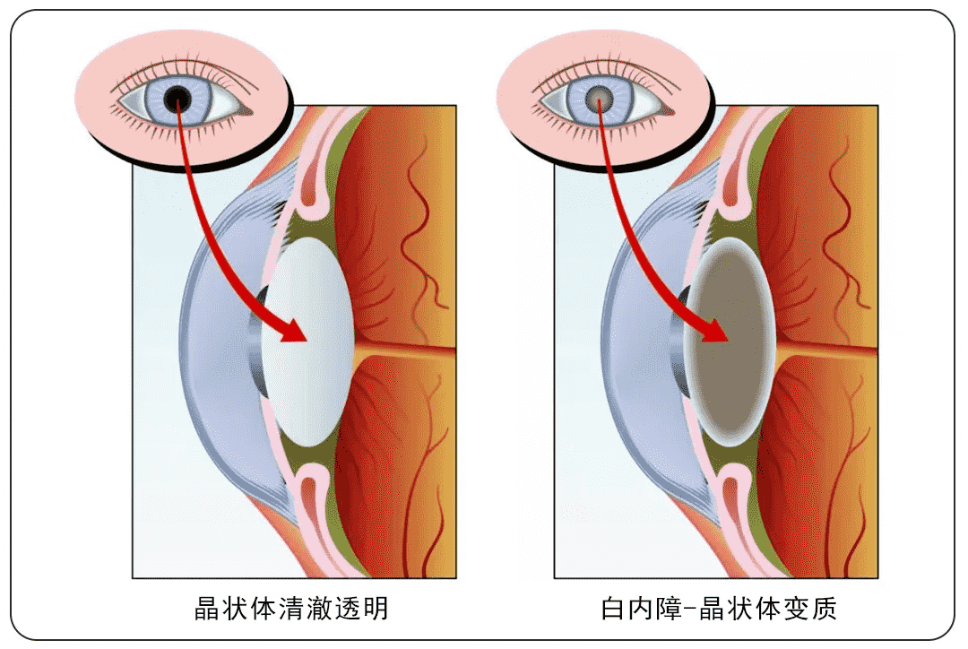 重慶高溫天氣下，普瑞眼科內(nèi)購(gòu)會(huì)護(hù)眼福利來(lái)襲