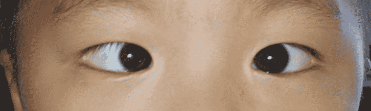 廈門(mén)眼科：奇！兩歲男童的眼睛竟然一天斜視，一天不斜視？