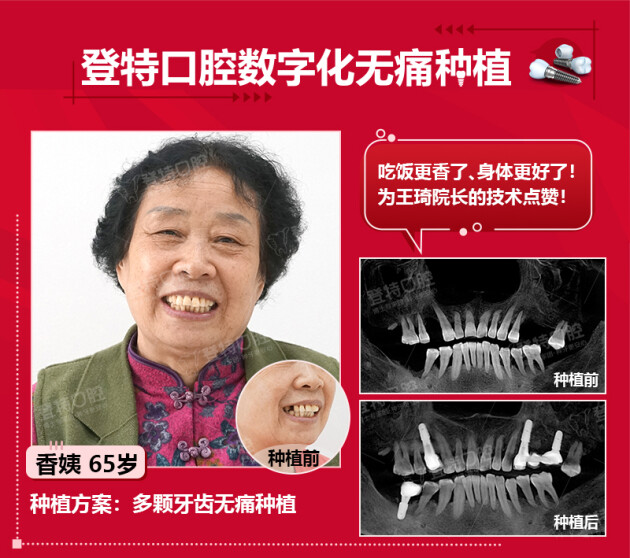 種植牙種好以后效果怎么樣？【佛山登特口腔】多位種牙顧客的真實分享！