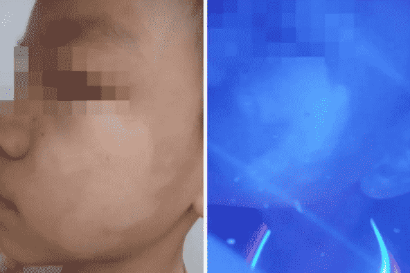 溫州中研白癜風醫(yī)院復色案例：孩子的白斑好了，笑逐顏開，給各位白友們增加信心！
