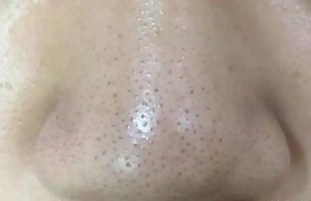 卸妝油怎么去黑頭？牙膏能去黑頭嗎？