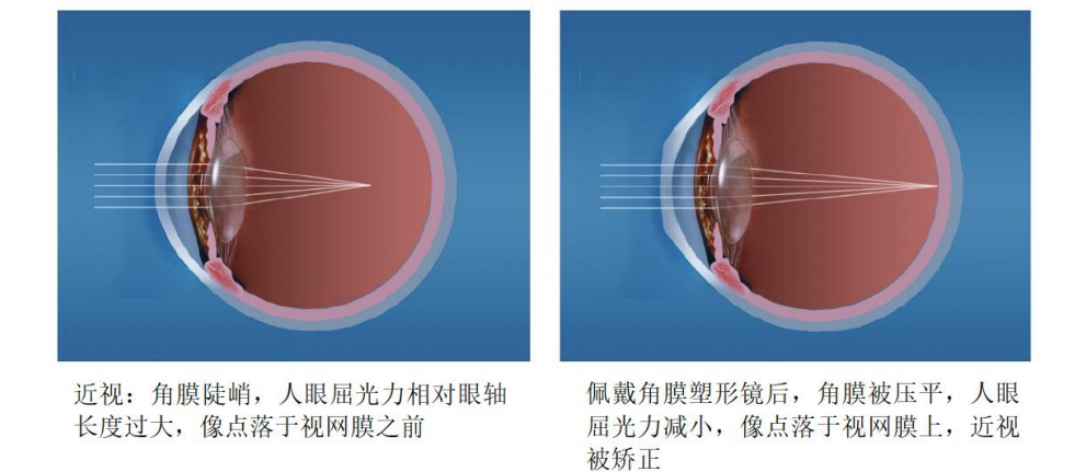 番禺普瑞科學(xué)配鏡總動(dòng)員 OK鏡控制近視增長(zhǎng)非常OK