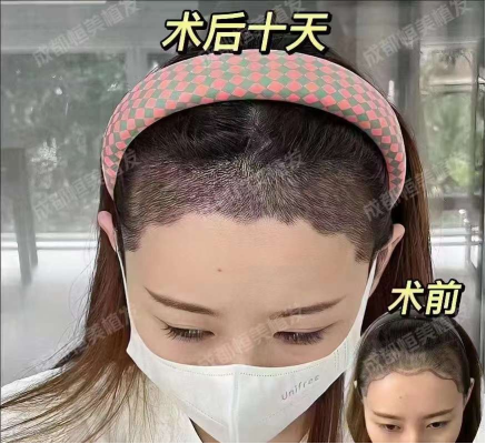  真實(shí)報(bào)道|成都恒美植發(fā)團(tuán)隊(duì)怎么樣？