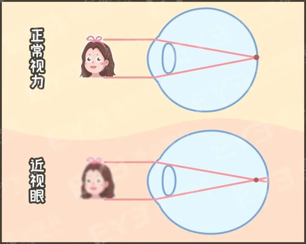 孩子戴上眼鏡度數(shù)會越來越高，確實(shí)如此嗎？——合肥愛爾眼科