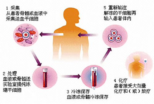 濟(jì)南血液病醫(yī)院科普：骨髓瘤患者做自體移植有用嗎？