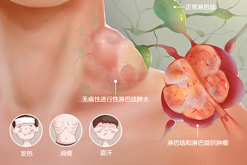  濟(jì)南血液病醫(yī)院科普：淋巴瘤患者的治療方法主要有哪些？
