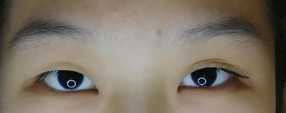王的整形王海木：雙眼皮時(shí)有時(shí)無(wú)？那是假性雙眼皮！