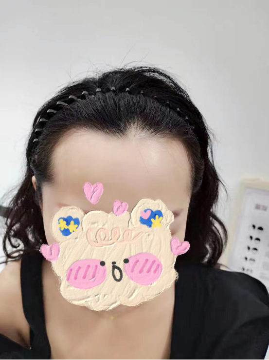 常年受脫發(fā)困擾，植發(fā)真的太香了！后悔沒(méi)有早點(diǎn)去成都恒美