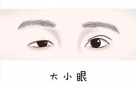 北京煤醫(yī)桂行軍醫(yī)生針對(duì)“大小眼”的問(wèn)題做的好嗎？