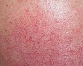 遼寧杏林整形外科醫(yī)院面部紅血絲?。。?！