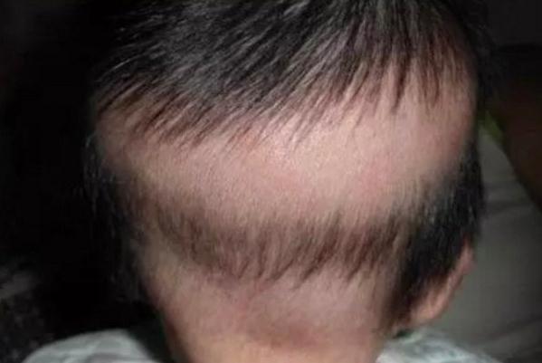 嬰兒枕禿頭發(fā)還會(huì)長嗎？嬰兒禿枕吃什么補(bǔ)？