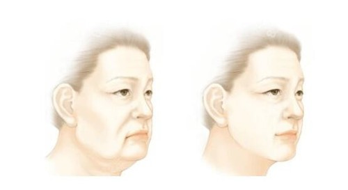 王的整形王海木：內(nèi)窺鏡拉皮除皺提升術(shù)能做多少次？