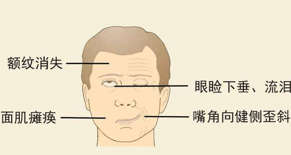 北京廣濟(jì)醫(yī)院怎么樣，治療面癱找對科室少走彎路