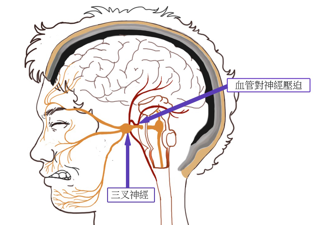 北京廣濟醫(yī)院好不好，如何治療三叉神經痛