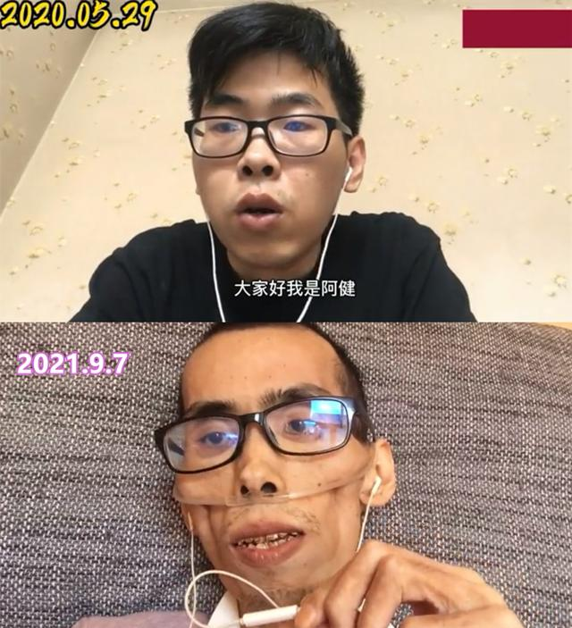 少了一次睡眠式胃腸鏡檢查，直腸癌病魔僅用了400多天讓他離開