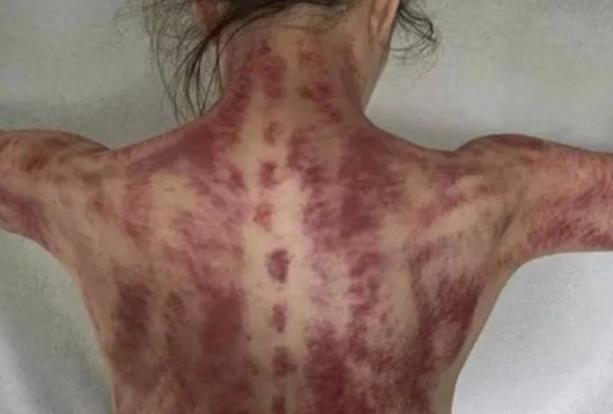 刮痧會越刮越虛嗎 什么情況下需要刮痧
