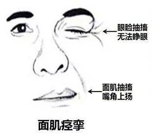 北京廣濟醫(yī)院好不好，得了面肌痙攣要注意哪些問題